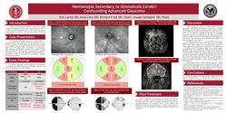 Hemianopia Secondary to Gliomatosis Cerebri Confounding Advanced Glaucoma